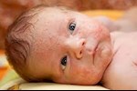لماذا يعاني طفلي حديث الولادة من حب الشباب؟
