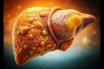 في أقل من شهر- طبيب يكشف طريقة لعلاج مرض الكبد الدهني