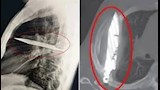 رجل يعيش 8 سنوات بشفرة سكين في صدره دون أن يدري "صور"