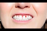 طرق طبيعية لإيقاف نزيف اللثة دون أدوية