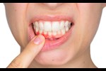 هل نزيف اللثة طبيعي أم يشير لمشكلة صحية؟