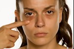 وداعًا للهالات السوداء- 10 وصفات طبيعية لعلاجها