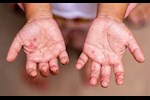 ما هو فيروس HFMD الذي تسبب في غلق أحد الفصول اليوم؟