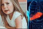 احذري- 6 أعراض تكشف إصابة طفلِك بدهون الكبد
