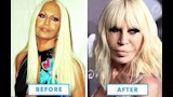  10 صور- نجوم عالميين تغيرت ملامحهم بعد عمليات تجميل من بينهم مادونا وميجان فوكس