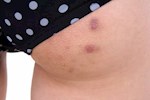 حب الشباب بالمؤخرة- هذه أسبابه وطرق التخلص منه         