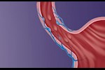 مضاعفات تليف الكبد- حسام موافي: يصيب المريء بهذا المرض 