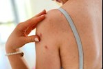 حب الشباب في الظهر للنساء- إليكِ أسبابه وطرق التخلص منه