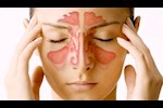 التهاب الجيوب الأنفية.. إليك حلول طبيعية للتخلص منه