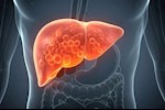  الدهون على الكبد- إليك أعراضها والفحوصات اللازمة لاكتشافها