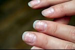 شكل الأظافر عند نقص الفيتامينات بالصور- 5 علامات احذرها