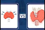  فرط نشاط الغدة الدرقية وخمولها- حسام موافي يوضح الفرق بينهما