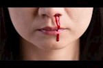هل تسبب الدورة الشهرية نزيف الأنف عند السيدات؟