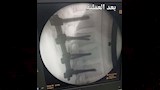 نجاح جراحة دقيقة لتثبيت كسر بالعمود الفقري
