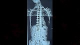 المريض بعد اجراء العملية  (4)