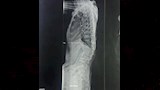 المريض بعد اجراء العملية  (3)