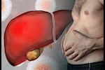 هل انتفاخ البطن من علامات الكبد؟- حسام موافي يحسم الجدل