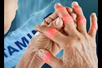 تظهر على أصابع اليدين.. 5 أعراض لنقص فيتامين B12 احذرها