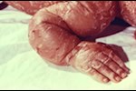 داء السمك الجلدي عند الأطفال- طبيب يوضح الأسباب وطرق العلاج