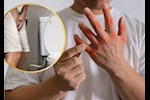 أعراض ارتفاع حمض اليوريك- 6 علامات تظهر في البول احذرها