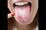 هذه أعراض فطريات الكانديدا.. طبيبة توضح طريقة منزلية للعلاج