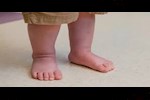 هذه مضاعفات القدم المسطحة عند الأطفال.. إليك طرق العلاج