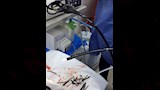 استخراج 100 مسمار وصامولة من معدة مريض (4)