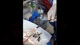 استخراج 100 مسمار وصامولة من معدة مريض (3)