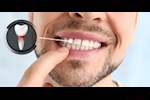 زراعة الأسنان مع فقدان جزء من عظام السن.. هل هذا ممكن؟ 