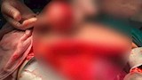 استئصال ورم نادر لمريض بالإسكندرية (2)