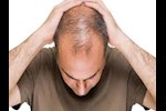 استخدام المينوكسيديل في علاج الصلع الوراثي.. هل يمكن منعه؟