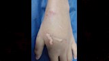 الطفلة رغد عقرها كلب فى يدها
