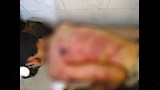 آثار التعذيب للطفل