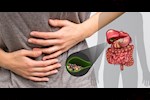 كيف تؤثر السمنة على حصوات المرارة؟ استشاري أمراض باطنة يجيب 