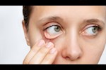 علامات نقص الحديد على الوجه والعين.. احذر ظهورها مبكرًا