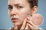 زيادة حب الشباب.. أطعمة ومشروبات تسبب حبوب الوجه تجنبها