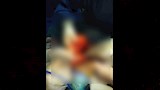 إنقاذ مريضة من ورم صديدي بالرقبة يعيق التنفس بالدقهلية