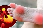 حسام موافي يحذر من علامة تظهر على القدمين بسبب الكوليسترول