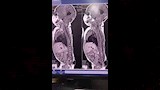 جراحة دقيقة تنقذ رضيعة (1)