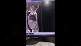 جراحة دقيقة تنقذ رضيعة (3)
