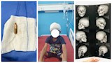 نجاح استخراج رصاصة من مخ طفل عمره 7 سنوات بسوهاج