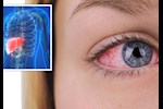 أعراض الكبد في العين- 5 علامات تظهر فيها تدل على تليفه  