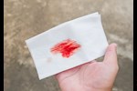 الدم في الرئة- حسام موافي يحذر: علامة على هذا المرض    