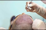 طبيبة تحذر: هذه أسباب فشل عملية زراعة الشعر "فيديو"    