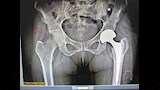 مستشفى الفكرية المركزي ينجح في استبدال مفصل فخذ لمريضة تعاني قصورًا بالقلب