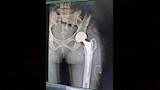 مستشفى الفكرية المركزي ينجح في استبدال مفصل فخذ لمريضة تعاني قصورًا بالقلب