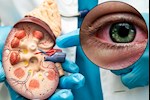 أعراض الفشل الكلوي- 4 علامات تظهر في العين احذرها      