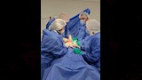 استخراج لولب مخترق للرحم من التجويف البطني (2)