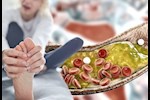 أعراض الكوليسترول على القدمين- 9 علامات تظهر في الصباخ 