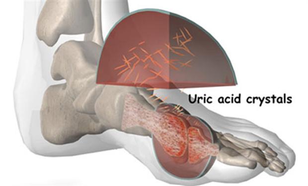 فيتامين “ج” يخفض فرص الإصابة بالنقرس بين الرجال